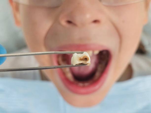 Best Emergency Tooth Extraction in Lebanon, TN